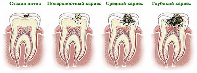 Стадии повреждения зубов кариесом
