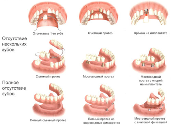 виды протезирования зубов